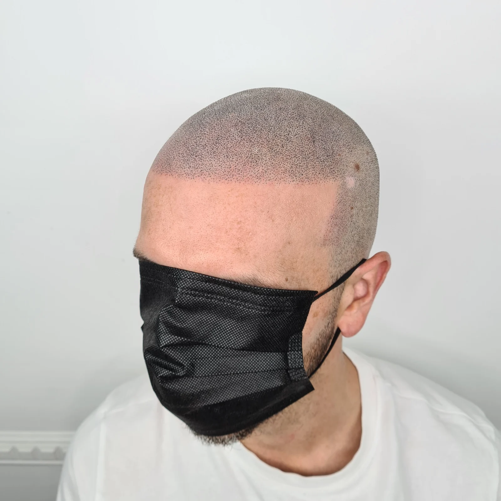 Natural scalp micropigmentation result from previous client work