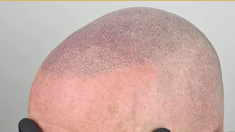 Scalp micropigmentation result at an angle