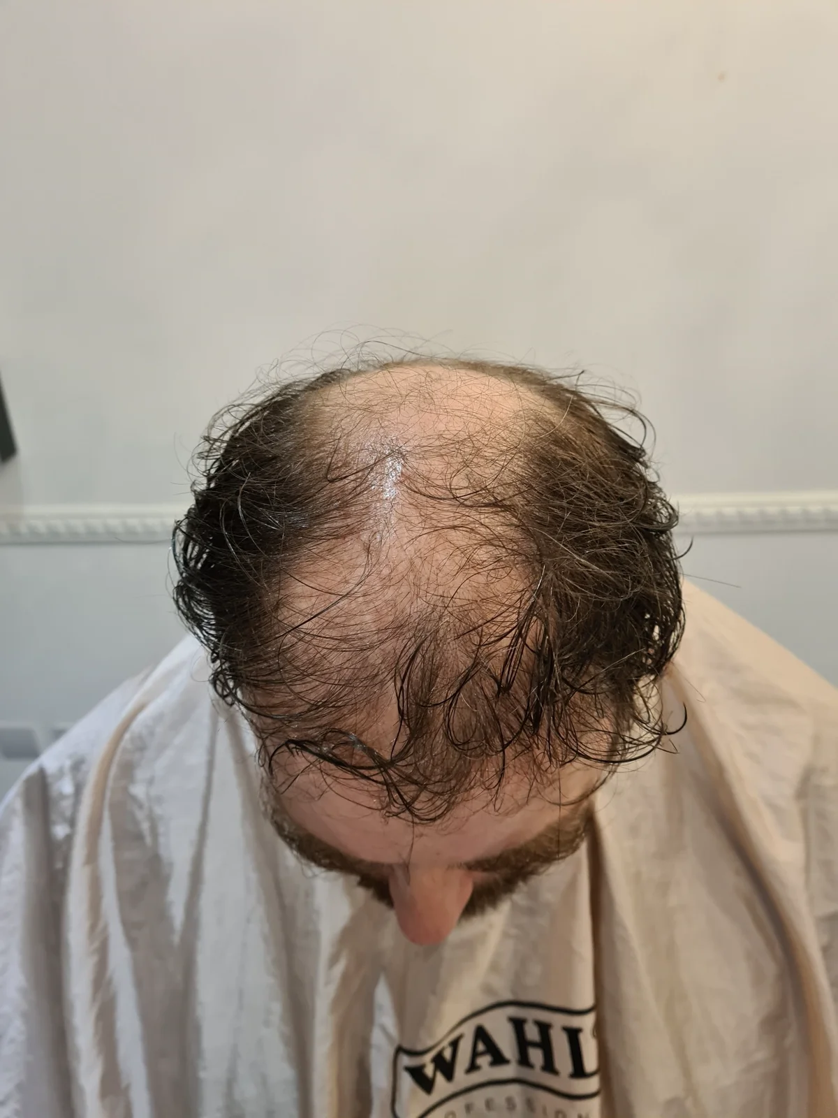 Example of advanced thinning before scalp micropigmentation treatment